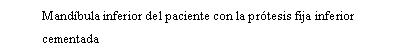 Cuadro de texto: Mandbula inferior del paciente con la prtesis fija inferior cementada